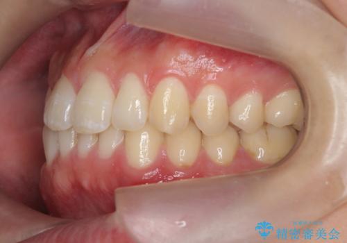前歯のすれ違い マウスピース矯正の治療前