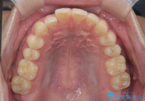 前歯のすれ違い　マウスピース矯正の治療前