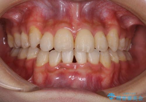 コロナ禍で矯正治療が中断:インビザラインで最終仕上げの症例 治療前