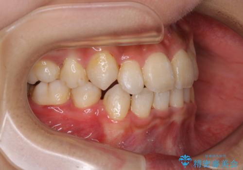 コロナ禍で矯正治療が中断:インビザラインで最終仕上げの治療前