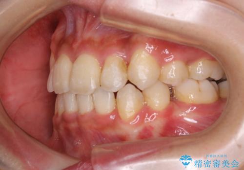 コロナ禍で矯正治療が中断:インビザラインで最終仕上げの治療前