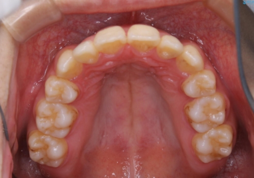 コロナ禍で矯正治療が中断:インビザラインで最終仕上げの治療前
