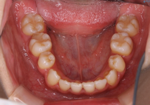 コロナ禍で矯正治療が中断:インビザラインで最終仕上げの治療前