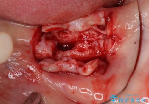 インプラントや歯周外科処置を用いた奥歯の補綴治療の治療前
