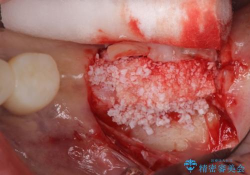インプラントや歯周外科処置を用いた奥歯の補綴治療の治療中