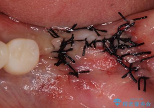 インプラントや歯周外科処置を用いた奥歯の補綴治療の治療後