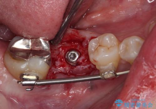 歯が全く咬みあわない　矯正と補綴の全顎治療の治療中