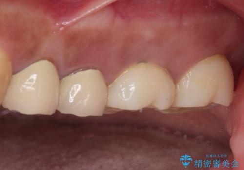 インプラントや歯周外科処置を用いた奥歯の補綴治療の治療前