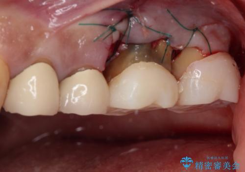 インプラントや歯周外科処置を用いた奥歯の補綴治療の治療中