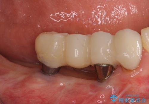 以前治療した歯がボロボロに 全顎補綴治療の治療前