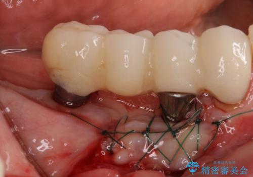 以前治療した歯がボロボロに　全顎補綴治療の治療中