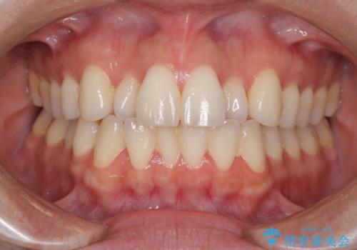 前歯のクロスバイト インビザラインによる矯正治療の症例 治療前