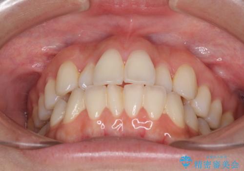 前歯のクロスバイト インビザラインによる矯正治療の治療前