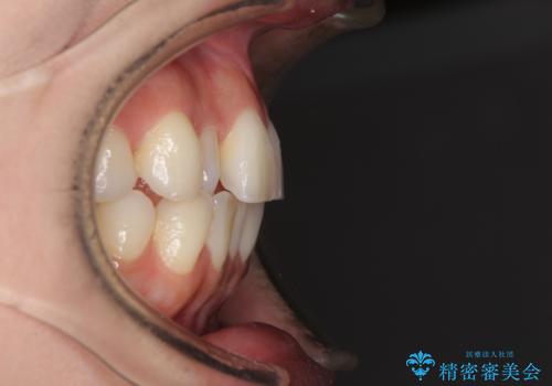 前歯のクロスバイト インビザラインによる矯正治療の治療前