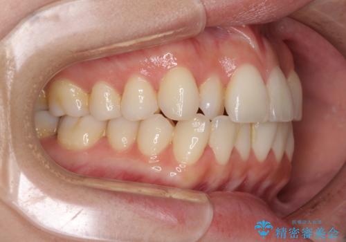 前歯のクロスバイト　インビザラインによる矯正治療の治療前