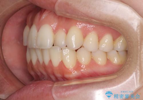 前歯のクロスバイト インビザラインによる矯正治療の治療前