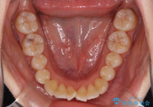 前歯のクロスバイト インビザラインによる矯正治療の治療前
