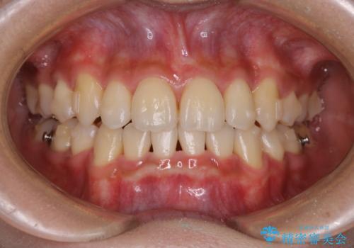 コロナ禍で矯正治療が中断:インビザラインで最終仕上げの治療中