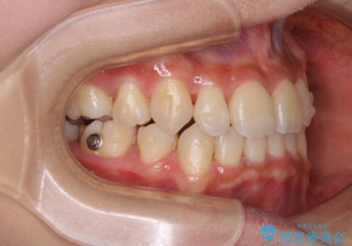 コロナ禍で矯正治療が中断:インビザラインで最終仕上げの治療中