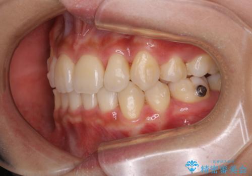 コロナ禍で矯正治療が中断:インビザラインで最終仕上げの治療中