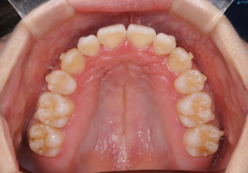 コロナ禍で矯正治療が中断:インビザラインで最終仕上げの治療中