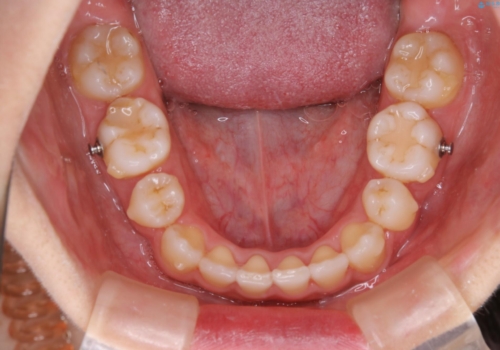 コロナ禍で矯正治療が中断:インビザラインで最終仕上げの治療中