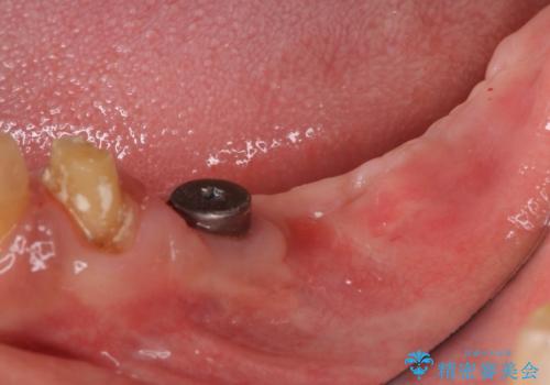 インプラントや歯周外科処置を用いた奥歯の補綴治療の治療前