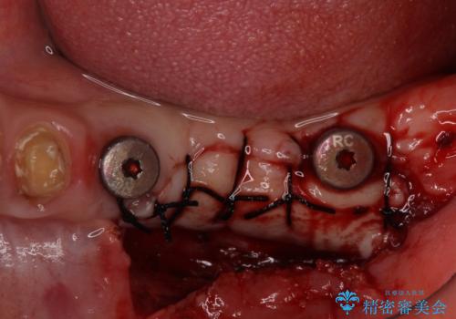 インプラントや歯周外科処置を用いた奥歯の補綴治療の治療中