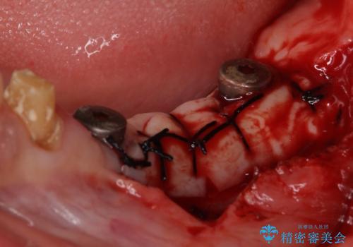インプラントや歯周外科処置を用いた奥歯の補綴治療の治療中
