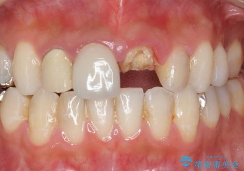 前歯が取れたの治療前