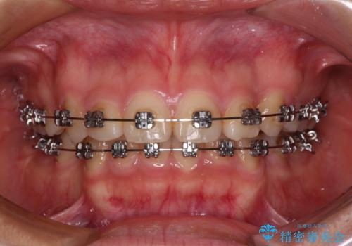 【モニター】治療途中で引っ越し ワイヤー装置を用いた抜歯矯正の治療中