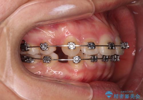 【モニター】治療途中で引っ越し ワイヤー装置を用いた抜歯矯正の治療中