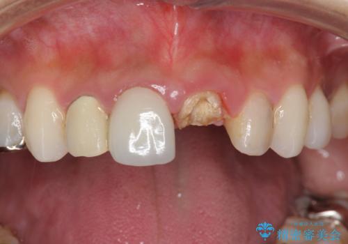 前歯が取れたの症例 治療前