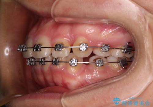 【モニター】治療途中で引っ越し ワイヤー装置を用いた抜歯矯正の治療中