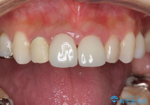 前歯が取れたの治療中