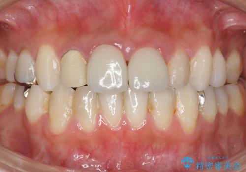 前歯が取れたの治療中