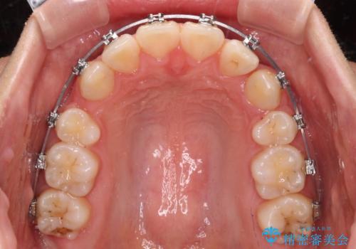 【モニター】治療途中で引っ越し ワイヤー装置を用いた抜歯矯正の治療中