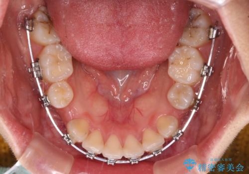 【モニター】治療途中で引っ越し ワイヤー装置を用いた抜歯矯正の治療中