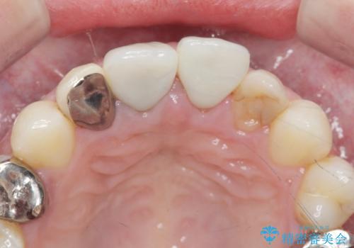 前歯が取れたの治療後