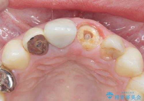 前歯が取れたの治療前
