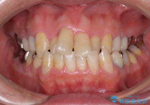 飛び出した前歯と目立つ銀歯 矯正とセラミックの総合歯科診療の症例 治療前