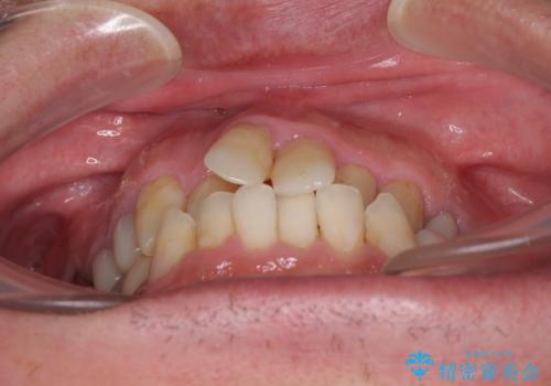 飛び出した前歯と目立つ銀歯 矯正とセラミックの総合歯科診療の治療前