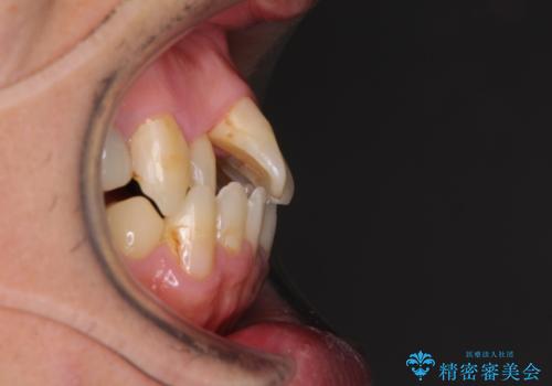飛び出した前歯と目立つ銀歯 矯正とセラミックの総合歯科診療の治療前