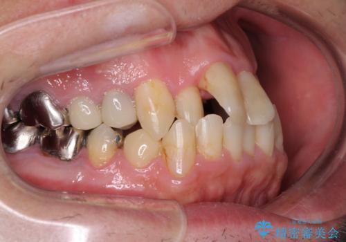 飛び出した前歯と目立つ銀歯 矯正とセラミックの総合歯科診療の治療前