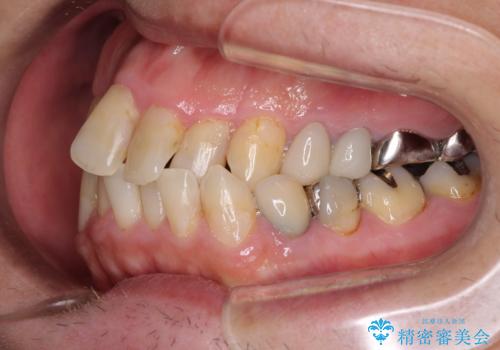 飛び出した前歯と目立つ銀歯　矯正とセラミックの総合歯科診療の治療前