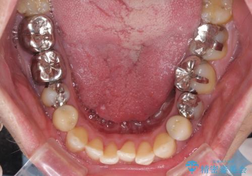 飛び出した前歯と目立つ銀歯 矯正とセラミックの総合歯科診療の治療前