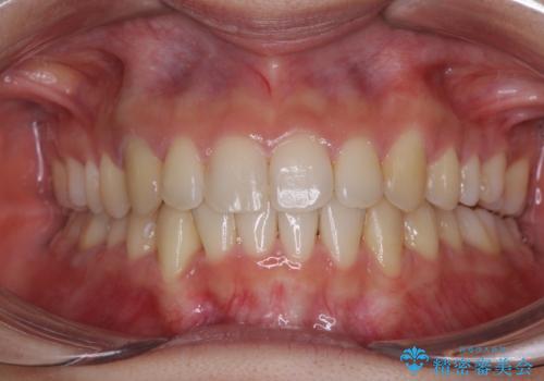 【モニター】下顎の気になる八重歯を改善　インビザラインによる矯正治療