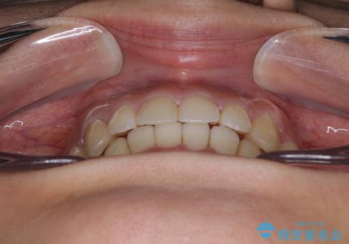 【モニター】下顎の気になる八重歯を改善　インビザラインによる矯正治療の治療後