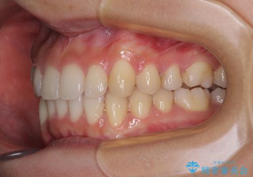 【モニター】下顎の気になる八重歯を改善　インビザラインによる矯正治療の治療後