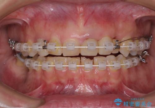 歯が全く咬みあわない 矯正と補綴の全顎治療の治療中